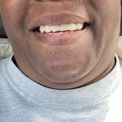 Family Dental Care Center - After front teeth extraction, a temporary replacement on the same day.