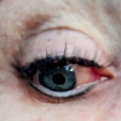 Lena's Salon and Spa - Irritated eye from poorly placed gel pad.