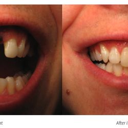 South Ogden Smiles - Before and After from South Ogden Smiles | South Ogden, UT