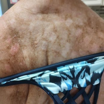 Body Beautiful - 2 months post IPL - Medical Spas Near Me - Cranberry Twp, Pennsylvania Body Beautiful - 2 months post IPL - Medical Spas Near Me - Cranberry Twp, Pennsylvania
