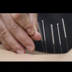 Acupuncture By Carmella Pingatore - Acupuncture
