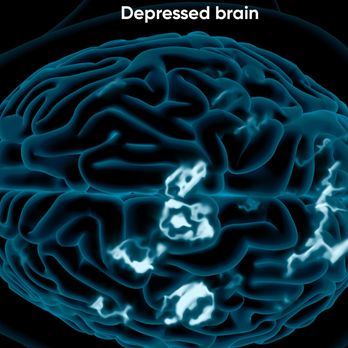Ocean Psychiatry - Depressed Brain - Psychiatrists Near Me - Fremont, California Ocean Psychiatry - Depressed Brain - Psychiatrists Near Me - Fremont, California