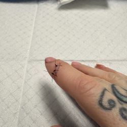 Alliance Urgent Care - Stitched finger