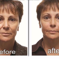 Richard M Foxx, MD - Radiesse is the best filler to improve the cheeks and nasolabial folds.