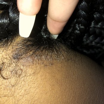 Majestik Braiding - Bumpy skin from hair being too tight and hair ripped out from scalp. - Hair Extensions Near Me - Hanover, Maryland Majestik Braiding - Bumpy skin from hair being too tight and hair ripped out from scalp. - Hair Extensions Near Me - Hanover, Maryland