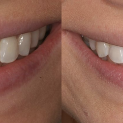 Artistic Expressions Dentistry - Before & After Results of Artistic Expressions Dentistry | Doylestown, PA