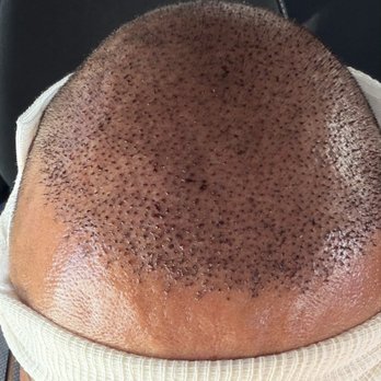 TJ Hair System - After my procedure all bandaged up - Hair Loss Centers Near Me - Tijuana, BCN TJ Hair System - After my procedure all bandaged up - Hair Loss Centers Near Me - Tijuana, BCN