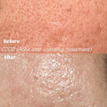 Brows To Brazilian - Before and after C2O2 facial for scarring, brightening and acne - Sugaring Near Me Brows To Brazilian - Before and after C2O2 facial for scarring, brightening and acne - Sugaring Near Me