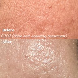 Brows To Brazilian - Before and after C2O2 facial for scarring, brightening and acne