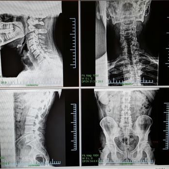 Lake Stevens Chiropractic - Digital X-rays Available here - Chiropractors Near Me - Lake Stevens, Washington