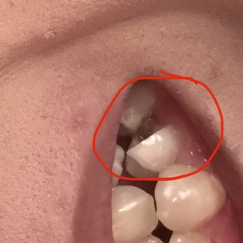 Taco Bell - Broken tooth from Naked chicken chalupa - Fast Food Near Me - Windsor, California