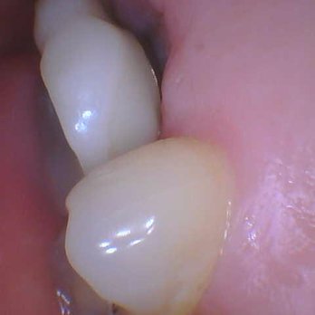 Regents Dental Group - Crown+implant done by Regents Dental. - Periodontists Near Me - La Jolla, California Regents Dental Group - Crown+implant done by Regents Dental. - Periodontists Near Me - La Jolla, California