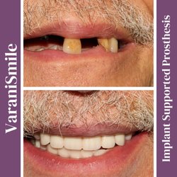 Varani Smile - An example of how implants can dramatically change your smile.
