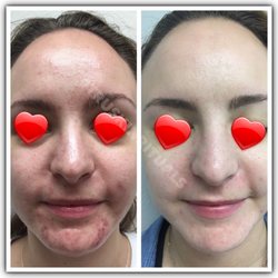 Specializing in Acne treatments and light therapy