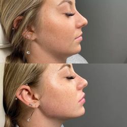 Venus Medical Aesthetics - Before and After jawline filler, chin filler, lip filler. #dermalfiller #lipfiller #jawlinefiller #chinfiller #medspa