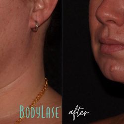 BodyLase Med Spa - CoolSculpting before and after for under the chin