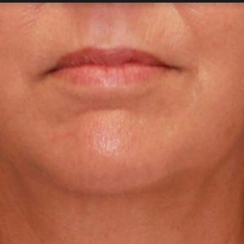 John W Tyrone, MD - This is my mouth BEFORE - Cosmetic Surgeons Near Me - Gainesville, Florida John W Tyrone, MD - This is my mouth BEFORE - Cosmetic Surgeons Near Me - Gainesville, Florida
