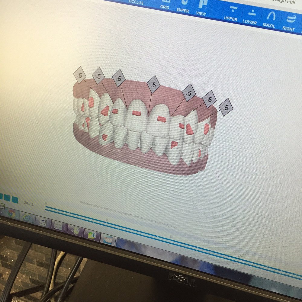 Santelli Orthodontics - As you age your teeth shift. Did you know that? - Orthodontists Near Me - Boca Raton, Florida Santelli Orthodontics - As you age your teeth shift. Did you know that? - Orthodontists Near Me - Boca Raton, Florida