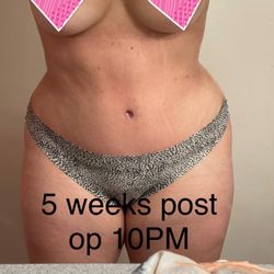Emil Kohan, MD - 5 weeks post op