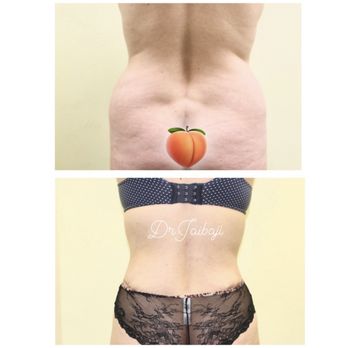 Moneer Jaibaji, MD - Tummy tuck and liposuction - Plastic Surgeons Near Me - San Diego, California Moneer Jaibaji, MD - Tummy tuck and liposuction - Plastic Surgeons Near Me - San Diego, California