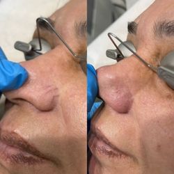 Omni Medspa - Spider Vein Removal