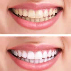 Beautiful Smile Dental Group - Bleaching Special For your special events this summer