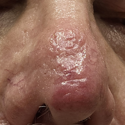 8 days after surgery
