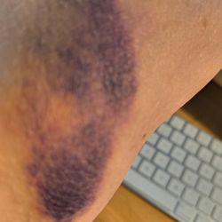 Beth Braver, MD - This over two days AFTER the blood draw.