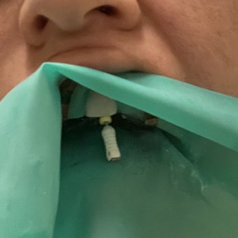 Apex Endodontics - This is when they took off the dental dam frame to take a midpoint x-ray. I couldn't feel a thing! - Endodontists Near Me - Costa Mesa, California