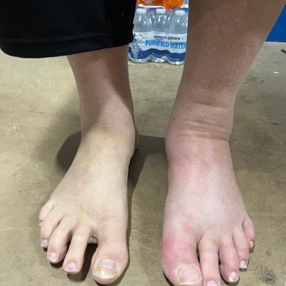 Arthritis Specialists - Entire foot swollen from gout - Rheumatologists Near Me - Mechanicsville, Virginia Arthritis Specialists - Entire foot swollen from gout - Rheumatologists Near Me - Mechanicsville, Virginia