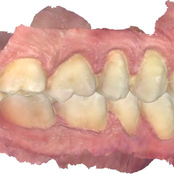 Aspen Dental - Palm Harbor, FL - More photos with the damage done after treatment. - General Dentistry Near Me - Palm Harbor, Florida Aspen Dental - Palm Harbor, FL - More photos with the damage done after treatment. - General Dentistry Near Me - Palm Harbor, Florida