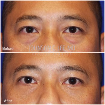 Johnson C. Lee, MD - Under eye bag removal (local anesthesia) - Cosmetic Surgeons Near Me - Beverly Hills, California
