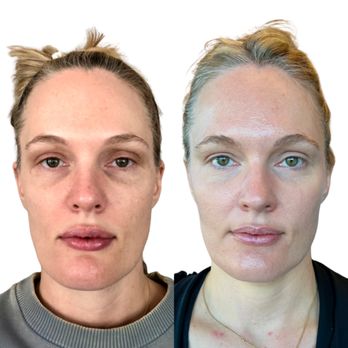 Theresa Carrie Aesthetics - Bad lip filler (not done by me) dissolved for a more natural look. - Nurse Practitioner Near Me - Denver, Colorado Theresa Carrie Aesthetics - Bad lip filler (not done by me) dissolved for a more natural look. - Nurse Practitioner Near Me - Denver, Colorado