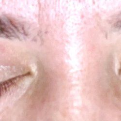 Queens Waxing Center - Second to last time with mild burn/scabbing. Last injury was much worse than what is pictured here.