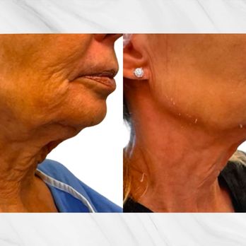 Roy Geronemus, MD - Avava - Before and after - Dermatologists Near Me - New York, New York Roy Geronemus, MD - Avava - Before and after - Dermatologists Near Me - New York, New York
