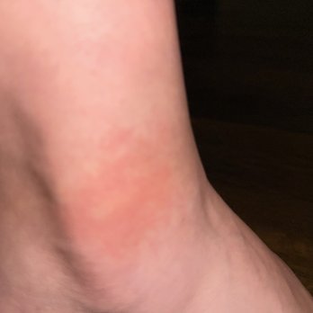 Pho House - ONE of the mosquito bites. - Vietnamese Near Me - Buena Park, California