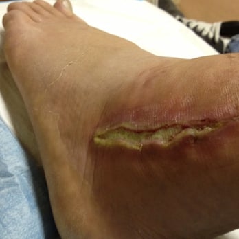 Nicholas A Abidi, MD - At the wound clinic with MRSA. - Orthopedists Near Me - Capitola, California