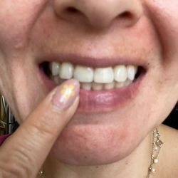 Apex Endodontics - 2 days post op my tooth is no longer gray!