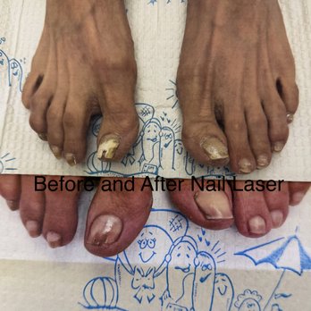 Michael R. Cook, Podiatry - Before and after nail laser treatments - Podiatrists Near Me - Miami, Florida Michael R. Cook, Podiatry - Before and after nail laser treatments - Podiatrists Near Me - Miami, Florida