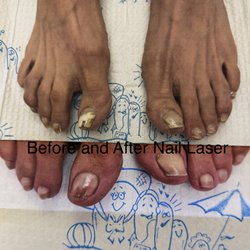 Michael R. Cook, Podiatry - Before and after nail laser treatments