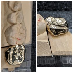 Raji Arunachalam Dds, PC - Casting and cementing a gold crown can be so much fun