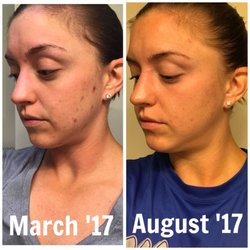Be Well Monterey - Shelly completely transformed my face and life! Here is my transformation from March to August working with her!