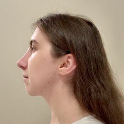 Aesthetic Facial Plastic Surgery - Dr. Philip Young MD - 8 months after surgery