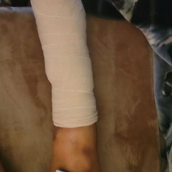 Low Country Orthopaedics - All done with surgery. Ankle is repaired. - Orthopedists Near Me - Summerville, South Carolina