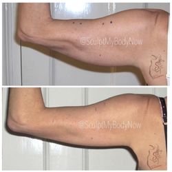 Body Sculpt Studios - GOT FLABBY ARMS!? We tighten & tone saggy, loose skin by restoring collagen and elastin. Book your appointment TODAY! 914-427-9395
