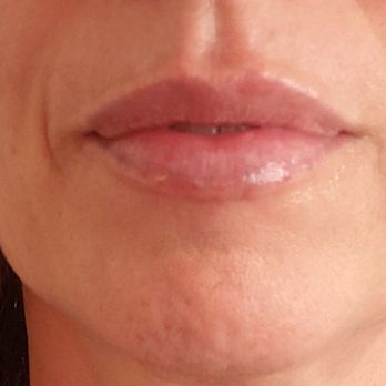 VIP Aesthetic Center - Después - Medical Spas Near Me - Hallandale Beach, Florida