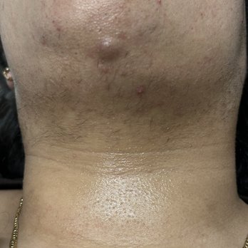 Electrolysis Group - Before electrolysis - Laser Hair Removal Near Me - Ontario, California