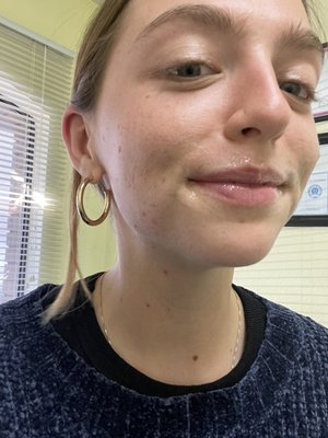 Salt Lake City Botox and Fillers