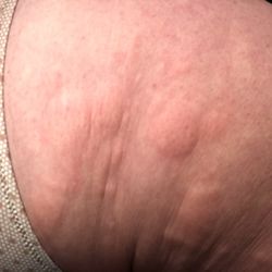 Collins Vacation Rentals - The bug bites on her thigh