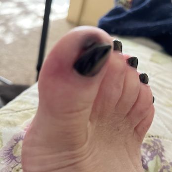 B & E Nails - Infected toe - Nail Salons Near Me - Stevensville, Michigan B & E Nails - Infected toe - Nail Salons Near Me - Stevensville, Michigan